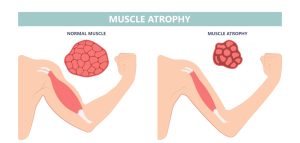 Muscle Damage Recovery: Quick Tips