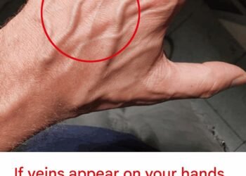 When to Worry About Veins That Appear Out of Nowhere