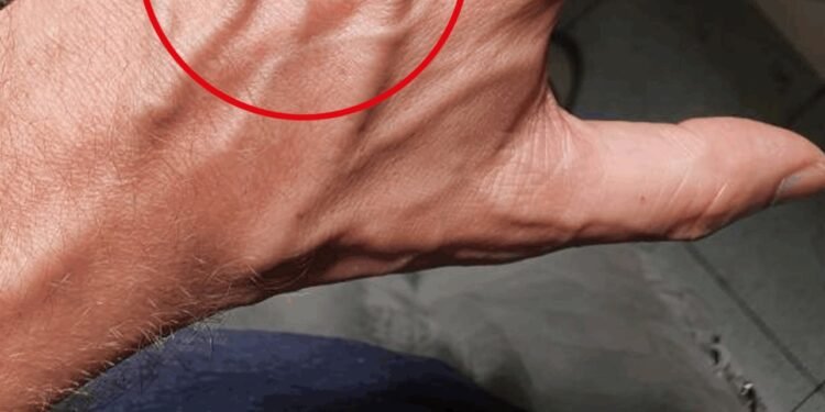 When to Worry About Veins That Appear Out of Nowhere