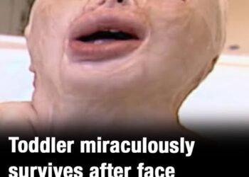 Toddler gets 90 percent burns and survives house blaze against all odds – this is her today
