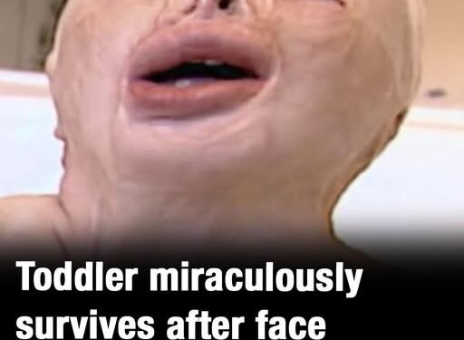 Toddler gets 90 percent burns and survives house blaze against all odds – this is her today