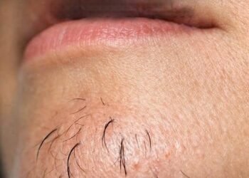 Why Chin Hair Grows in Women and What It May Indicate