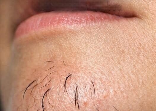 Why Chin Hair Grows in Women and What It May Indicate
