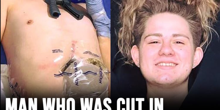 19-year-old crushed by forklift chooses to amputate bottom half of his body