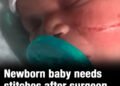 Newborn baby needs 13 stitches after surgeon ripped open her face during C-section