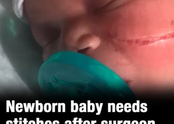 Newborn baby needs 13 stitches after surgeon ripped open her face during C-section