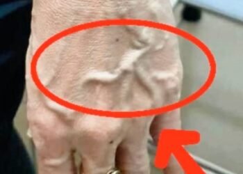 If Someone Has Visible Veins, Does It Mean Their Circulation Is Poor?