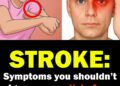 ONE MONTH BEFORE A STROKE, YOUR BODY MAY SEND THESE WA:RNING SIGNS — AND THEY CAN BE DIFFERENT FOR MEN AND WOMEN