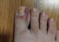 How to Treat an Ingrown Toenail at Home: Tips and Natural Remedies