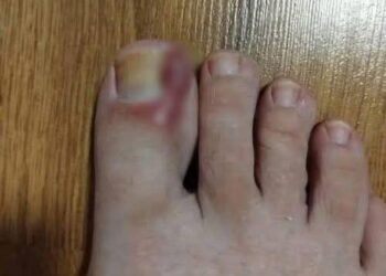 How to Treat an Ingrown Toenail at Home: Tips and Natural Remedies