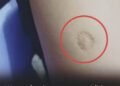 That Small Round Scar on Your Arm May Trace Back to a Historic Vaccine Campaign