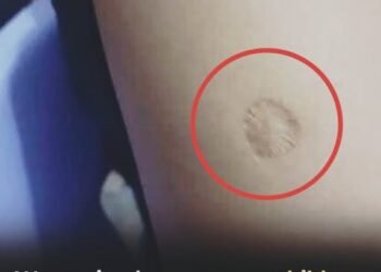 That Small Round Scar on Your Arm May Trace Back to a Historic Vaccine Campaign