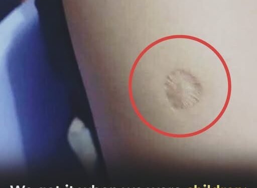 That Small Round Scar on Your Arm May Trace Back to a Historic Vaccine Campaign