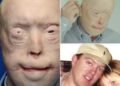 Firefighter suffers third-degree burns – this is him 11 years later