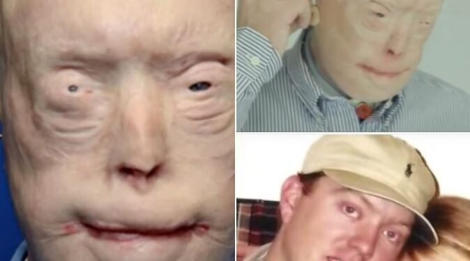 Firefighter suffers third-degree burns – this is him 11 years later