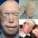 Firefighter suffers third-degree burns – this is him 11 years later