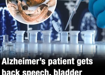Alzheimer’s patient recovers speech and memories in groundbreaking drug trial