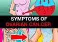 Subtle Symptoms That Could Signal Ovarian Cancer, According to Health Experts