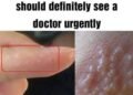 If you see these painful red bumps, you may have dyshidrotic eczema