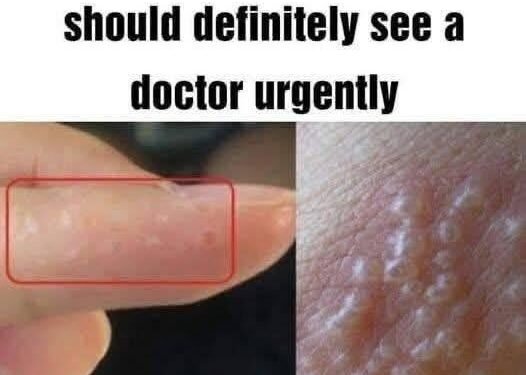 If you see these painful red bumps, you may have dyshidrotic eczema