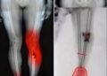 New Research May Help Explain Rare Heart Inflammation Cases After Vaccination