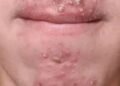 Been dating this woman I met at Walmart and after finally getting some I woke up with these on my face what is this?