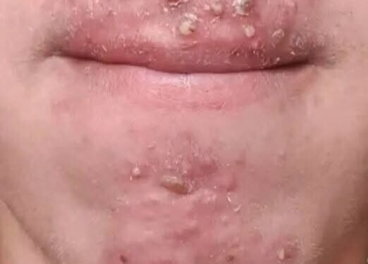 Been dating this woman I met at Walmart and after finally getting some I woke up with these on my face what is this?