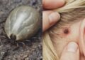 Found a Weird Bug in Your Child’s Hair? What Parents Should Know