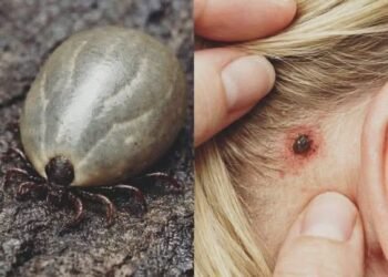 Found a Weird Bug in Your Child’s Hair? What Parents Should Know