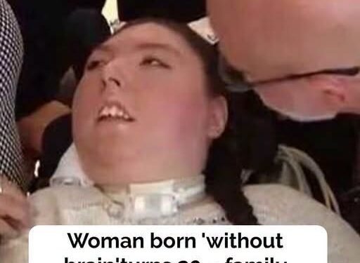 Woman born without brain turns 20, family calls her ‘miracle’