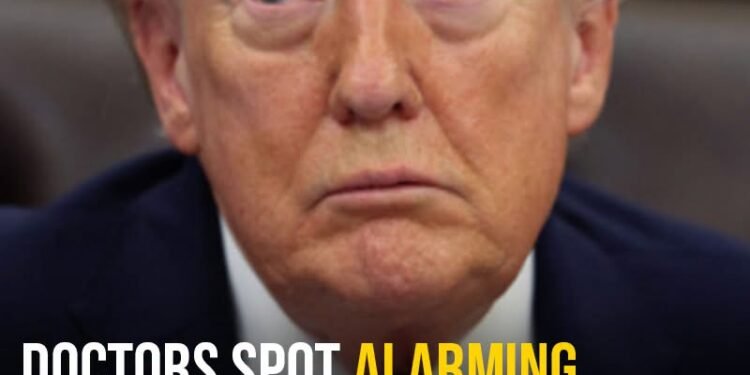 Doctors spot alarming health ‘marker’ in Donald Trump that could raise risk of premature death