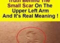 Smallpox vaccine scars: What they look like and why