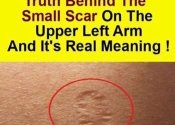 Smallpox vaccine scars: What they look like and why