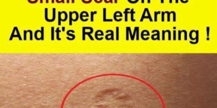 Smallpox vaccine scars: What they look like and why