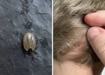 Does Anyone Know What Kind of Bug This Could Be? A Parent Finds an Unusual Insect on a Child’s Scalp
