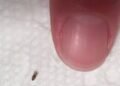 Head lice: How to get rid of them and stop them coming back