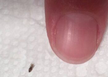 Head lice: How to get rid of them and stop them coming back
