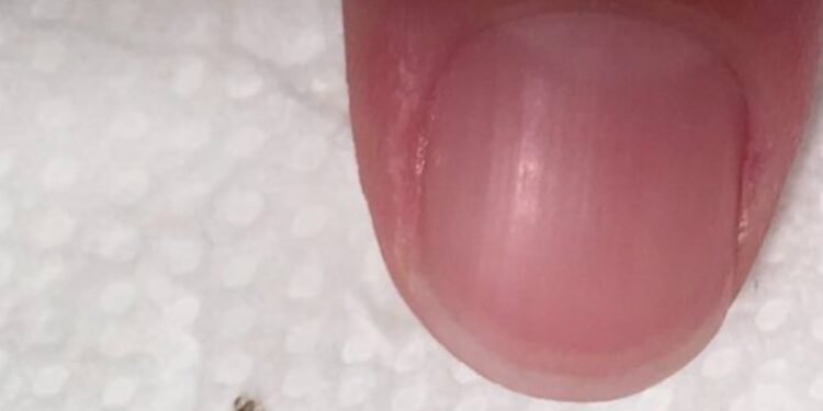 Head lice: How to get rid of them and stop them coming back