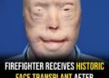 Firefighter suffers third-degree burns – this is him 11 years later