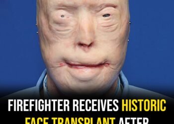 Firefighter suffers third-degree burns – this is him 11 years later