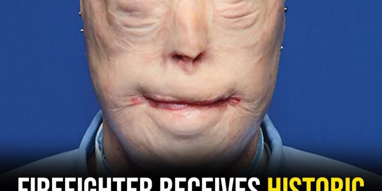 Firefighter suffers third-degree burns – this is him 11 years later