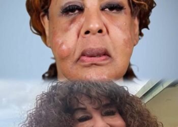 A fake doctor injected cement and superglue into her face. This is what she looks like today. 💪