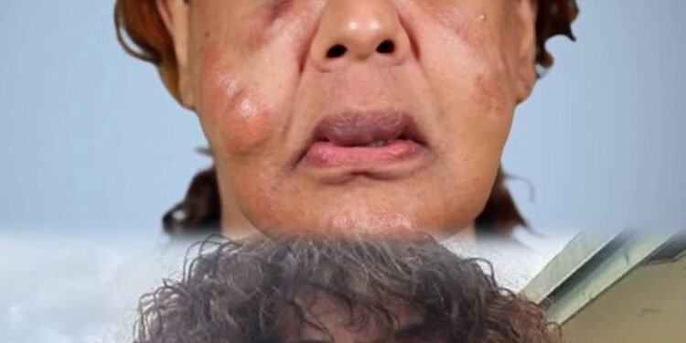 A fake doctor injected cement and superglue into her face. This is what she looks like today. 💪