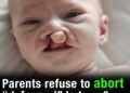 Parents refuse to abort deformed baby when doctors ask – their little boy ended up defying all odds