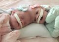 Conjoined twins Abby and Erin Delaney: Inside their remarkable story