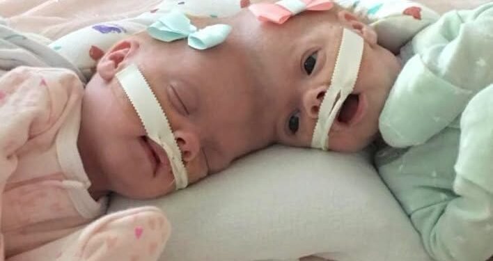 Conjoined twins Abby and Erin Delaney: Inside their remarkable story