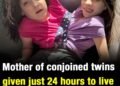 Mother of conjoined twins given just 24 hours to live reveals why she refused to separate them