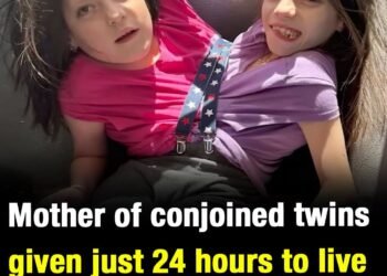 Mother of conjoined twins given just 24 hours to live reveals why she refused to separate them