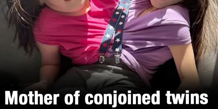 Mother of conjoined twins given just 24 hours to live reveals why she refused to separate them
