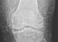 Doctors find “gold mine” in woman’s knees
